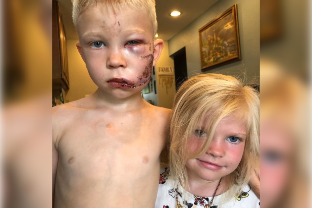 Após salvar irmã de ataque de cachorro, menino de 6 anos leva mais de 90 pontos no rosto